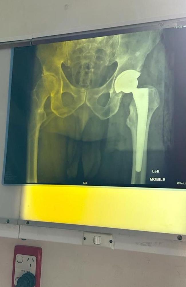 She also shared an X-ray of her father’s hip in hospital. Picture: Instagram