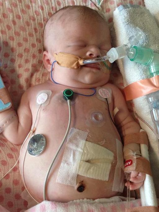 The tot had both kidneys removed in the first nine days of her life. Picture: Supplied