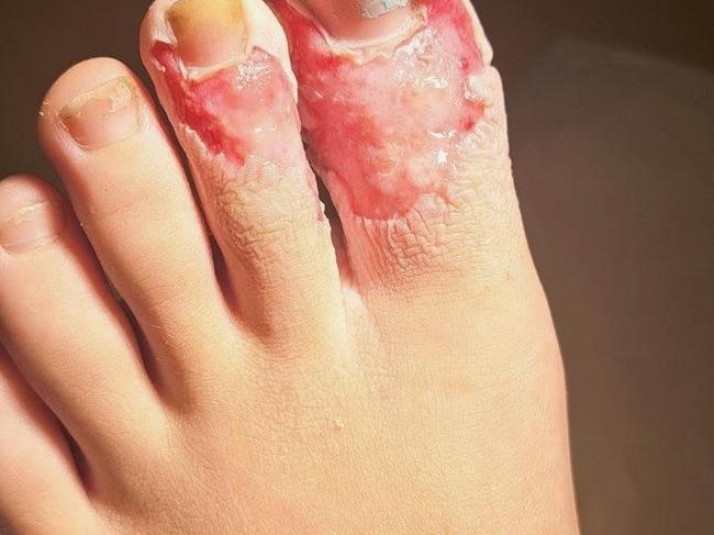 Violet’s foot was badly burnt while she was trying to follow the recipe on TikTok. Picture: Supplied