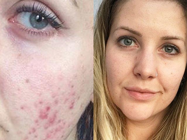 ONE TIME WEB USE ONLY - FEE APPLIES FOR REUSE -  BRIGHTON, UK: Then and now. AN inspirational British woman has revealed how she overcame her fifteen-year struggle with acne thanks to adopting a natural approach to skincare and sharing her journey on Instagram, after being dismissed by doctors who told her that hormone filled medication would be her only chance of having clear skin. Digital content lead, Amy Saunders (27) from Brighton, UK, was just 11-years-old when her acne started on a family holiday to the Caribbean. Putting her change in complexion down to the suncream she was using, Amy expected her skin to return to normal after she came home but it didnâ€™t. Throughout her teens, Amyâ€™s spots didnâ€™t bother her too much as she assumed that it was something she would soon grow out of. It wasnâ€™t until she came off her contraceptive pill at 24 that her skin flared up like never before and she felt unable to leave the house without a full face of makeup out of fear of strangersâ€™ negative comments and her own poor self-confidence. Formerly a makeup artist for film and TV, she tried to â€˜kidâ€™ herself into thinking she had clear skin through her skilled makeup application. Struggling with her self-image like never before, the advice Amy received from doctors was to go back on the pill or start Accutane, a medicine used to treat very severe acne. From this, she started her blog, Skyn Therapy to chart her own natural healing journey and to inspire others wanting to pursue this route instead of medication â€“ she explained the healing process and how she looks after her skin and body now. Amy Saunders / Skyn Therapy / mediadrumworld.com  Picture: Media Drum World/australscope