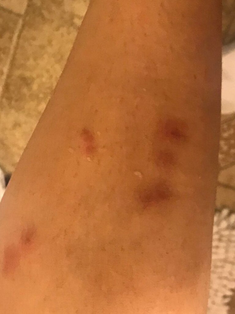 Photos show alleged bed bug bites on actress Connie Flores and her husband Alvin.