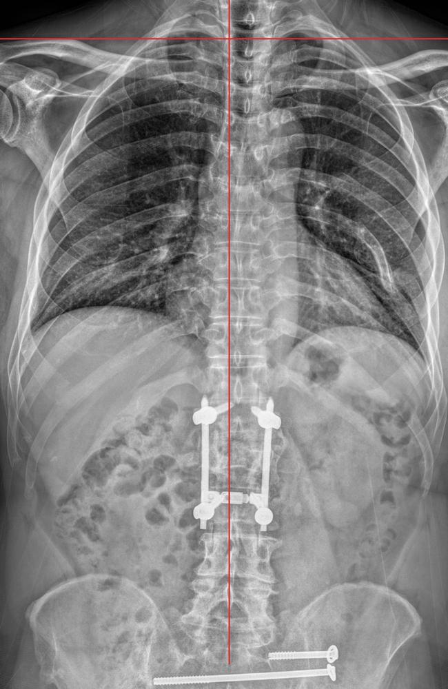 X-rays of Mr Ludwig’s spinal damage. Picture: Supplied