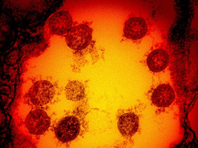 (FILES) In this undated handout image obtained July 15, 2020, courtesy of National Institute of Allergy and Infectious Diseases(NIH/NIAID), shows a transmission electron micrograph of SARS-CoV-2 virus particles, isolated from a patient, captured and color-enhanced at the NIAID Integrated Research Facility (IRF) in Fort Detrick, Maryland. - US pharmaceutical firm Eli Lilly on October 13, 2020 paused a late-stage trial of its experimental lab-produced antibody treatment against Covid-19 over an unspecified safety concern, the company said. "Lilly is supportive of the decision by the independent DSMB (data safety monitoring board) to cautiously ensure the safety of the patients participating in this study," a spokesperson told AFP in a statement. (Photo by Handout / National Institute of Allergy and Infectious Diseases / AFP) / RESTRICTED TO EDITORIAL USE - MANDATORY CREDIT "AFP PHOTO /NATIONAL INSTITUTE OF ALLERGY AND INFECTIOUS DISEASES/HANDOUT " - NO MARKETING - NO ADVERTISING CAMPAIGNS - DISTRIBUTED AS A SERVICE TO CLIENTS