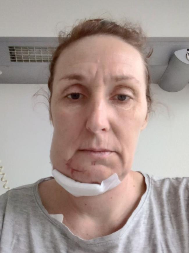 Oksana Serhiienko in hospital after being shot in the face. Supplied