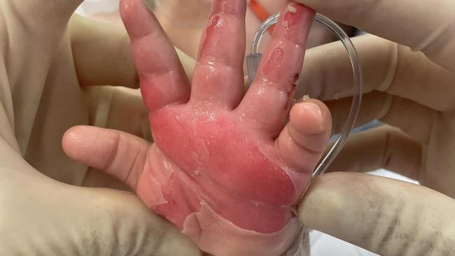 A young child playing at a Port Macquarie water park fell onto a nearby metal grate leaving severe burns requiring hospital treatment.