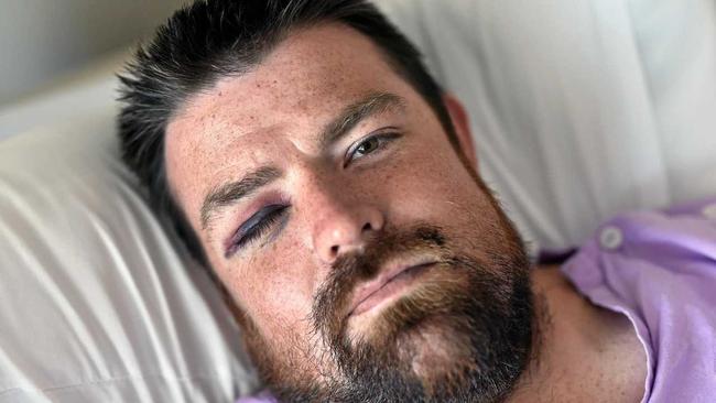 Josh Leighton was walking from Alex Surf club to watch the fireworks at Mooloolaba on New Year's Eve when he was coward punched in an unprovoked attack. He's still in hospital with multiple head fractures and bleeding to the brain, and has no memory of what happened.