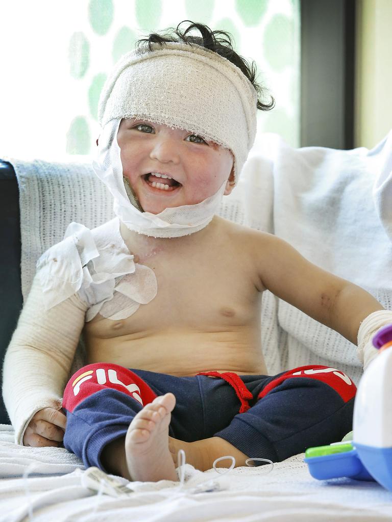 Ryan Haidari, one, bravely plays with a toy car to take his mind off his burnt head, neck and arm. Picture: David Caird