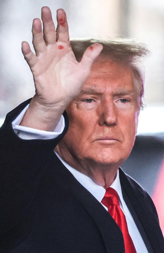 Red spots on Donald Trump’s hand cause revealed The Courier Mail