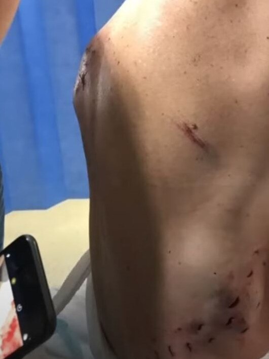 Ms Bootes suffers shark bites to her shoulder blade, hip and torso. Picture: 7News