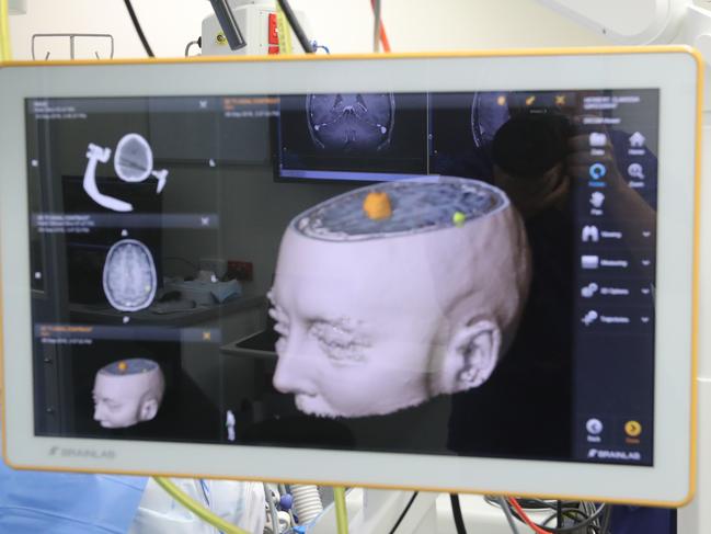 Doctors do brain surgery on a patient at Greenslopes Hospital.  Pic Peter Wallis