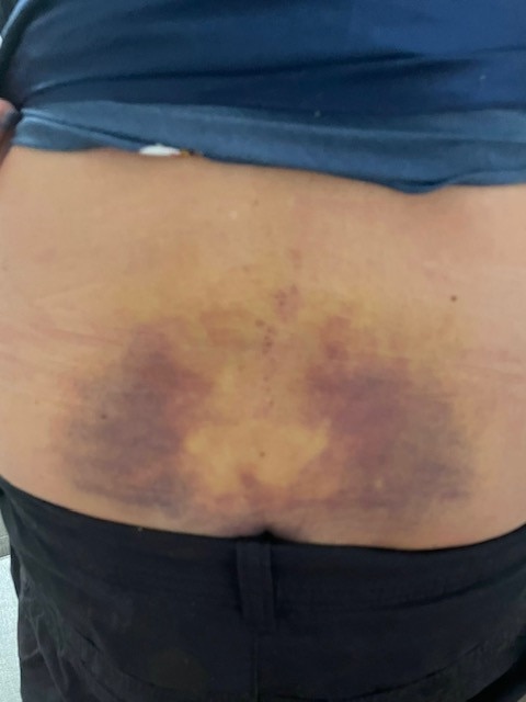 A photo of bruising caused in the incident.