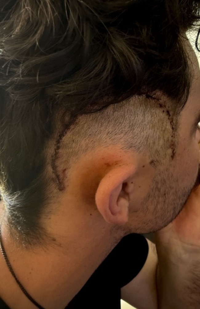 Michael Maloney had a part of his brain removed during surgery. Photo: Supplied