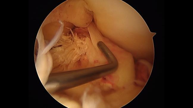 What happens when the ACL tears?