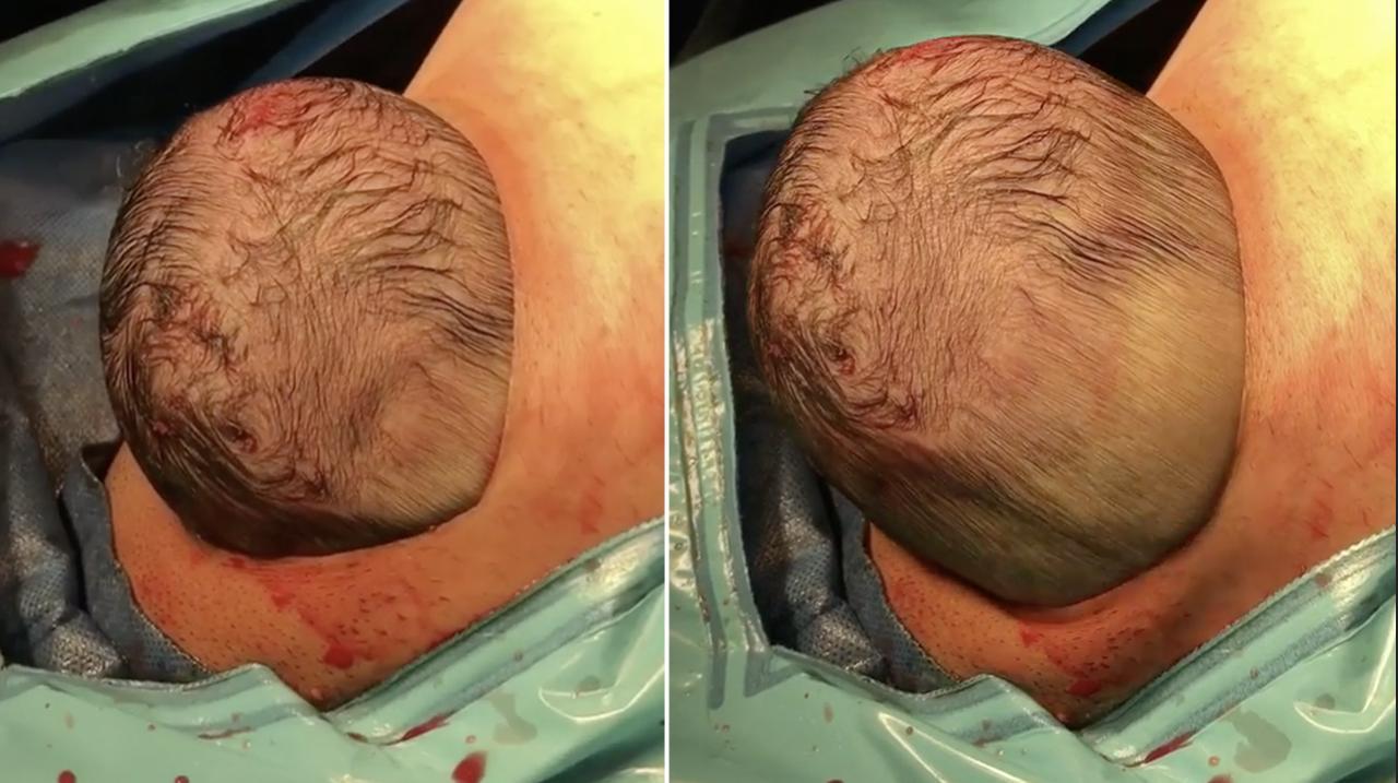 Baby's head pops out during gentle c-section