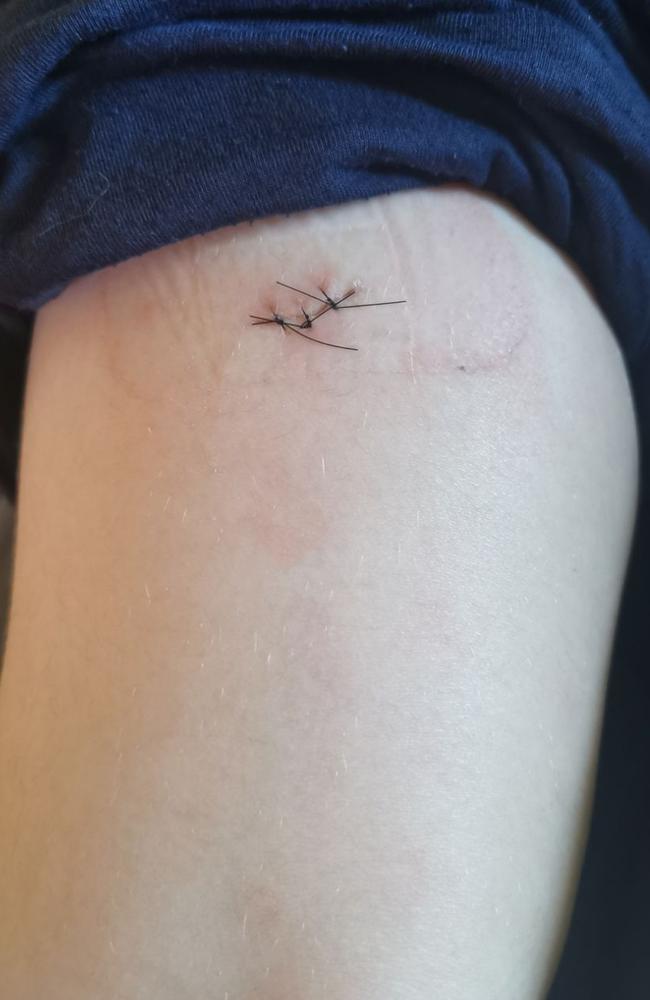 A deep 3cm-long laceration caused to a Year 6 student at West Ulverstone Primary School accidentally by a knife on August 14, 2023. Picture: Supplied