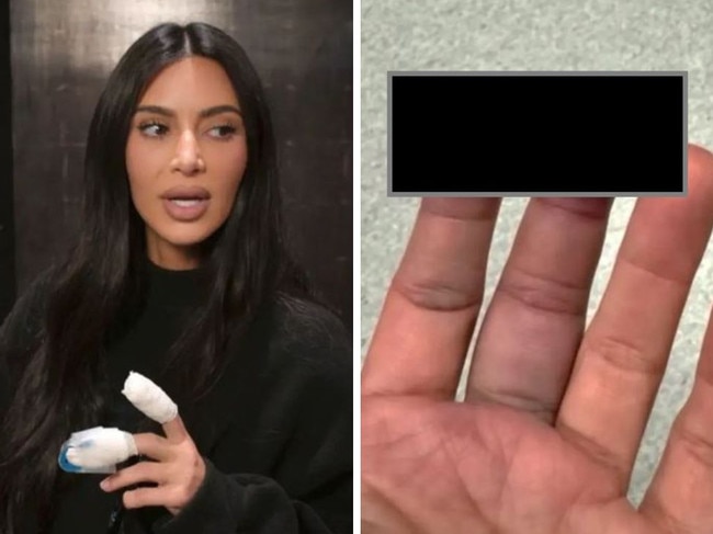 Kim Kardashian reveals finger injury