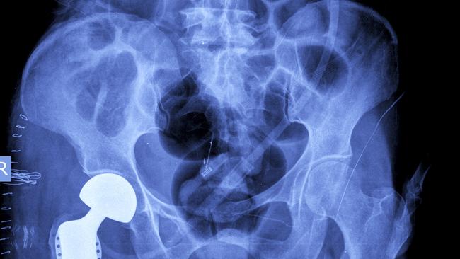 A ­replacement hip in a private hospital costs $3000 more on average, at $9626, compared with $6299 in the public­ system. Picture: istock