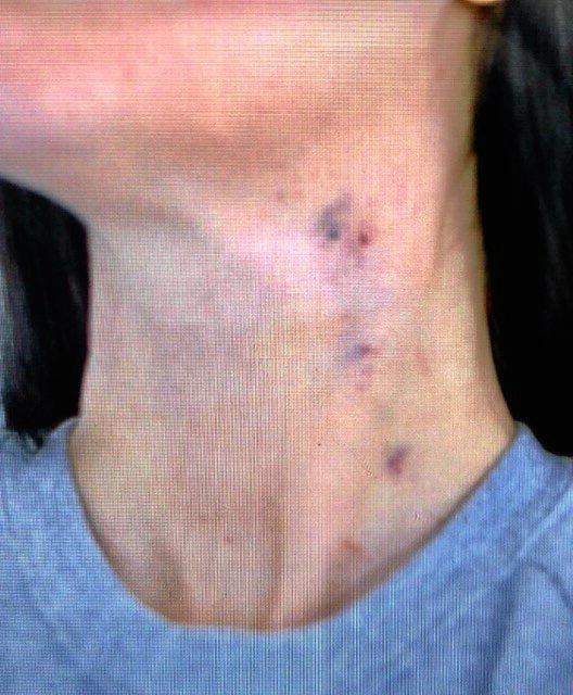 DOMESTIC VIOLENCE: Krista Hepi-Tehuia was not only left with bruising on her neck after her husband's hands wrapped around it so tight she almost lost consciousness - she was left with the sense that she did something wrong. Picture: Contributed