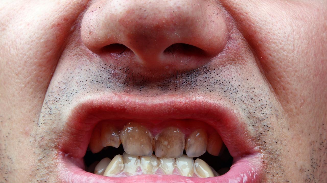 Tooth decay cost Australians a mouth-watering $4.5bn in 2019-2020 alone. Picture: Supplied.