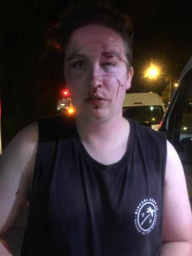 James Beange, 18, received massive facial injuries when assaulted at a bus stop at Mona Vale early on New Year's Day.