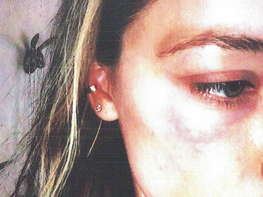 Bruising on Amber Heard’s face she claims was inflicted by Johnny Depp. 