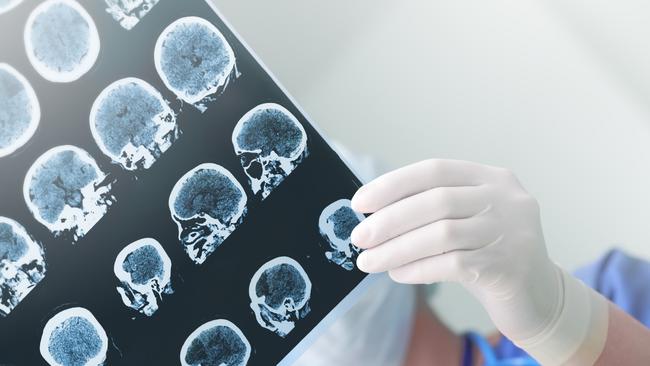 Stroke patients could one day improve their recovery by taking drugs that revert their brains to a child-like state.