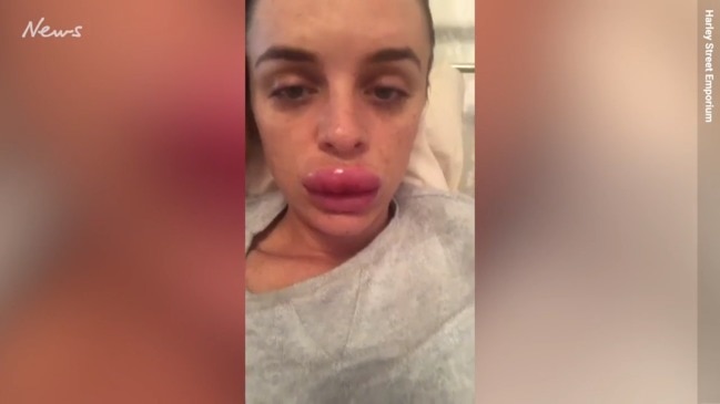 Woman Reveals Why She Got Lip Fillers At 19 9194