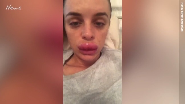 Woman's mouth 'quadruples' after Botox