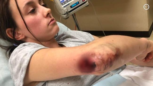 Courtney Herbert’s arm was caught in roller machinery at a rock salt factory in Whyalla. Picture: Supplied