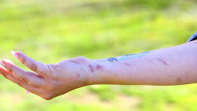 Tanyka Ford shows the scars on her arm from where she tried the break through the window to save her girls from the fire. Picture: Toby Zerna