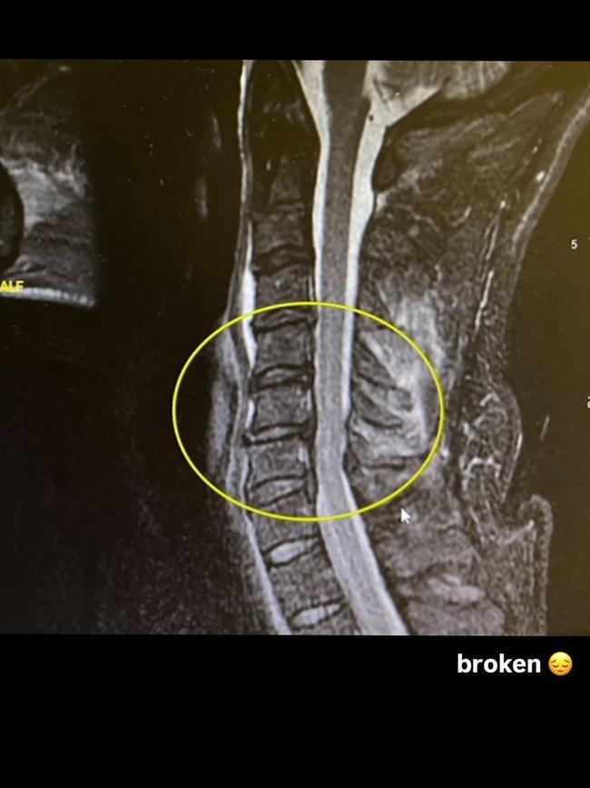 The MTV star shared X-rays of his broken neck on Instagram.