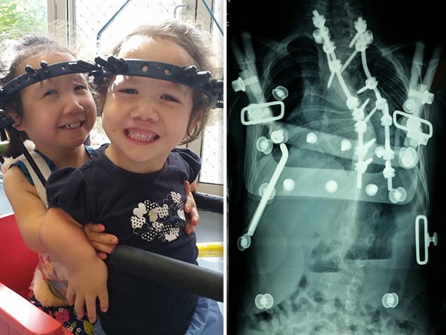 Maddy and Briella in their halos (left), and an X-ray showing how the intricate devices are fitted to the twisted spine.