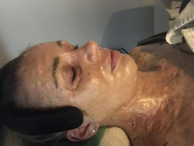 The ‘Game of Thrones’ facial will have you looking like an alien for a few minutes during treatment.