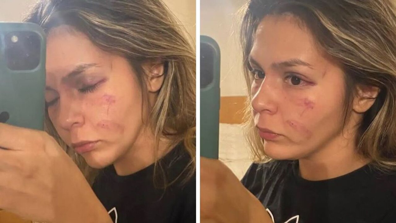 Mexican fighter Brianda Tamara, taking a selfie showcasing her injuries from a 2022 fight with Imane Khelif.