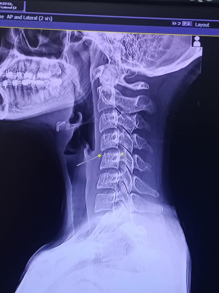 An X-ray of Chanada’s neck. Picture: Ping Chanada/Facebook