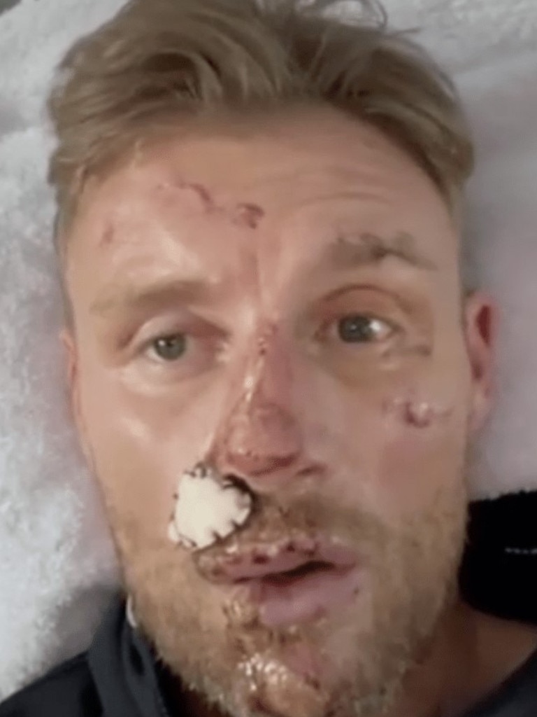 Freddie Flintoff’s injuries have been revealed. Picture: BBC1