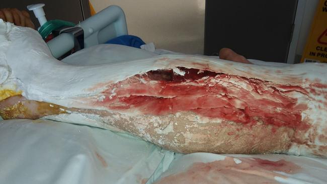 Jacob Ross's leg cast before Dubbo Base Hospital staff attended to it. Picture: Supplied