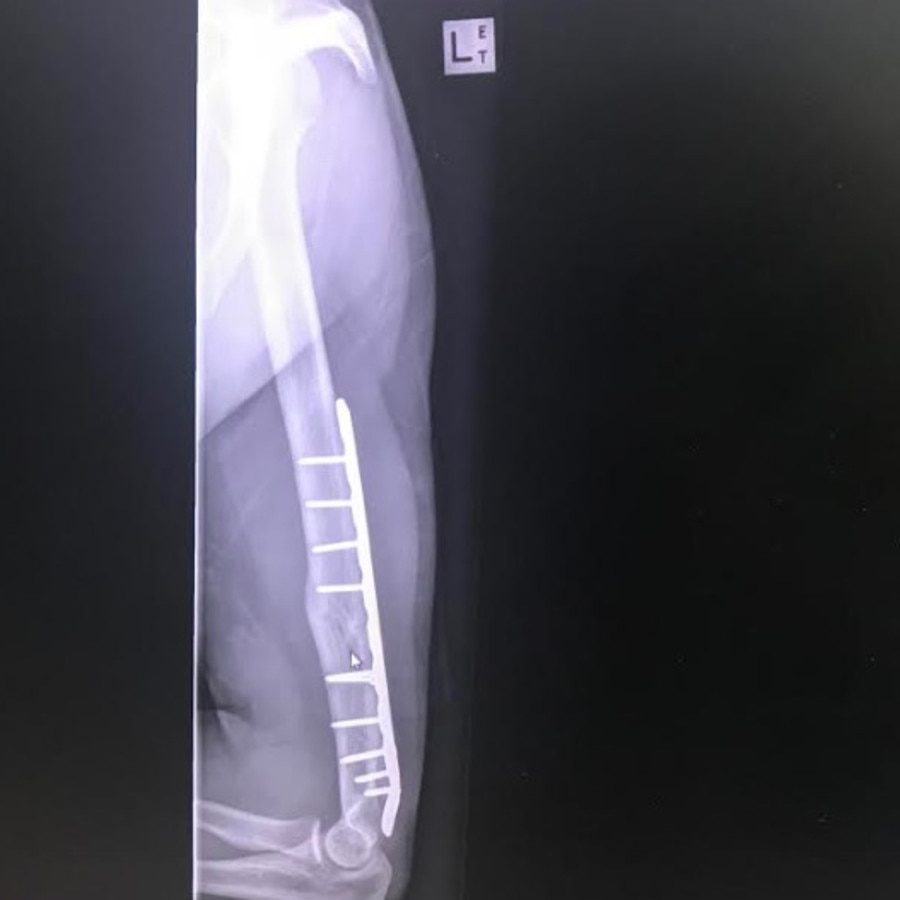 He now has a titanium rod permanently in his arm. Picture: Jacob Pearce