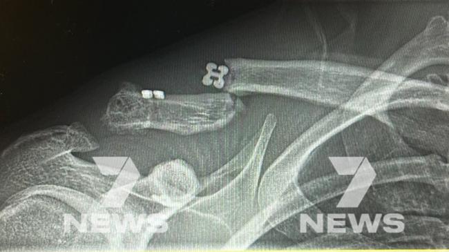 X-Ray scans of Jack Steele's broken collarbone. Picture: Mitch Cleary, Twitter