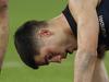 ‘Failure of the system’: Lyon slams Blue’s concussion delay