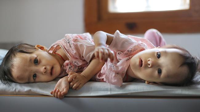 Nima and Dawa, the 14-month-old conjoined twins at the referral hospital in Thimphu, Bhutan, where they have spent most of their lives. Picture: Alex Coppel