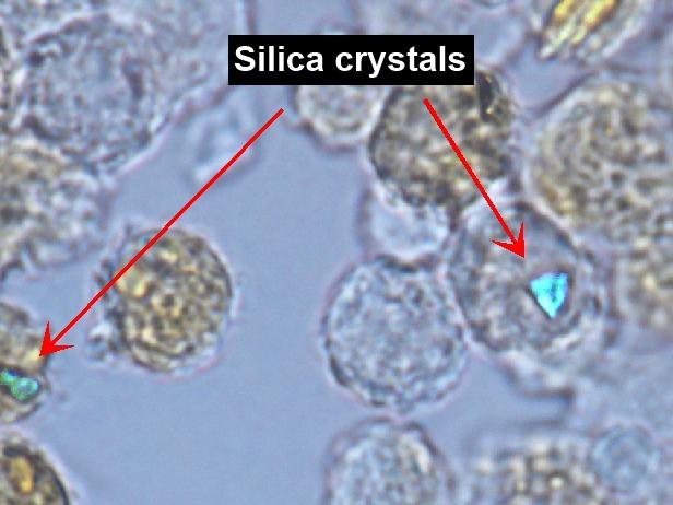 EXCLUSIVE: World first treatment for deadly silicosis