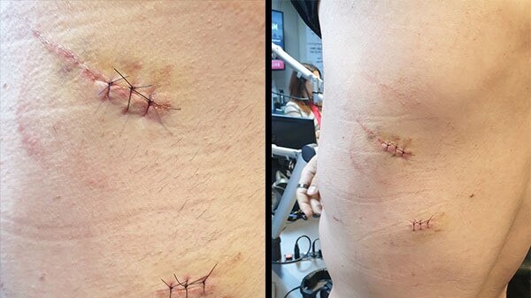 Bar worker Lawrence D’iapico-Bien has been left with scars after being stabbed in the back during an altercation at work. Picture: 2GB