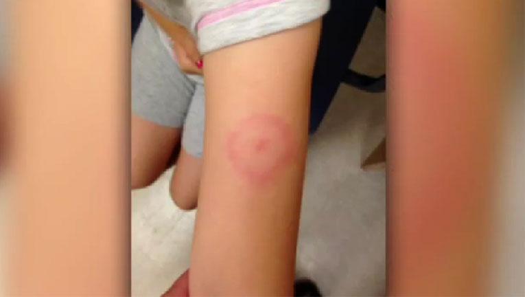 Child diagnosed with Lyme disease after tick bite