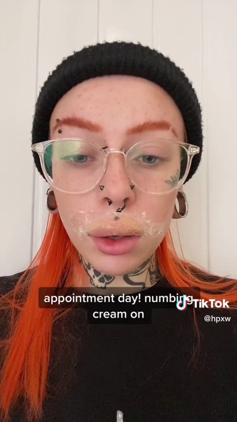 Hollie Worm took to TikTok to document the process of getting her filler dissolved. Picture: @hpxw