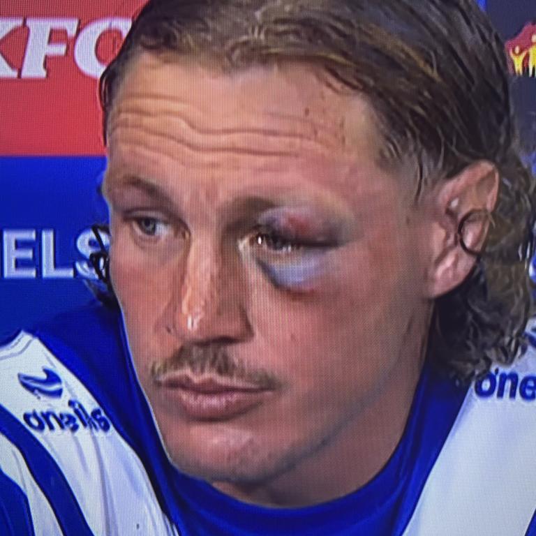 Canterbury's Kurt Mann looking like Rocky Balboa post match. Picture: Fox League