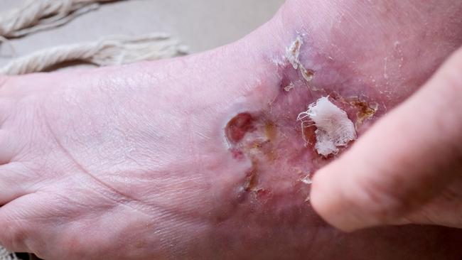 Buruli ulcer. Picture: Mark Wilson