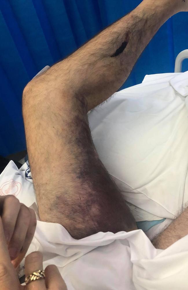 A picture of Nev Scott's leg after being run over.