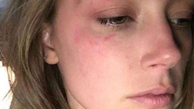 Amber Heard has accused Johnny Depp of leaving her bruised after an alleged attack by the actor. Picture: Supplied