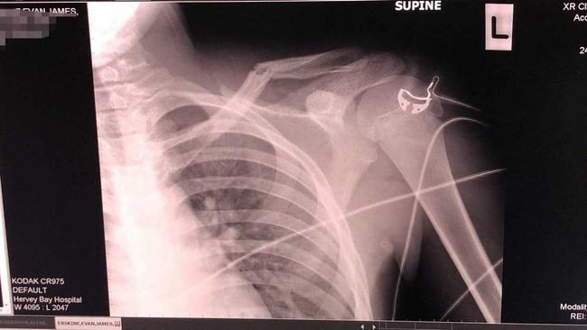 Evan Erskine, 14, broke his collarbone after a dog ran after him on his BMX push bike and caused him to crash. Picture: Contributed